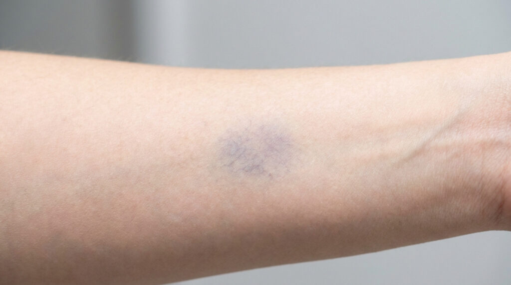Gros plan sur un avant-bras à la peau claire présentant une marque violacée circulaire, ressemblant à une ecchymose.